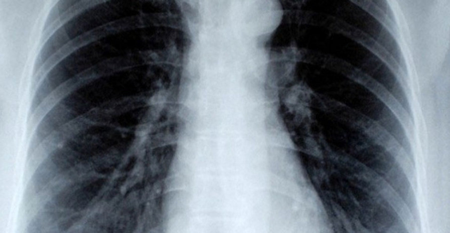 Mikor érdemes mellkas röntgent végezni?