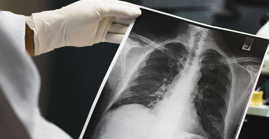 Mikor érdemes mellkas röntgent végezni?