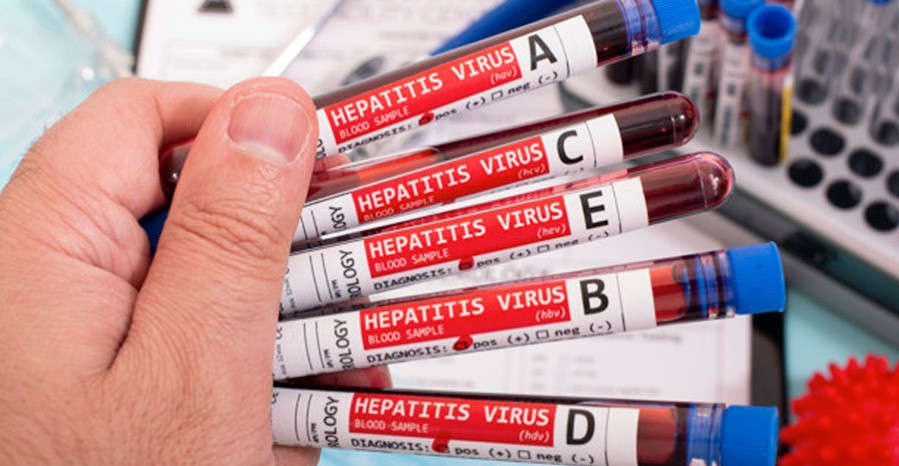 Milyen tünetei lehetnek a hepatitisznak?